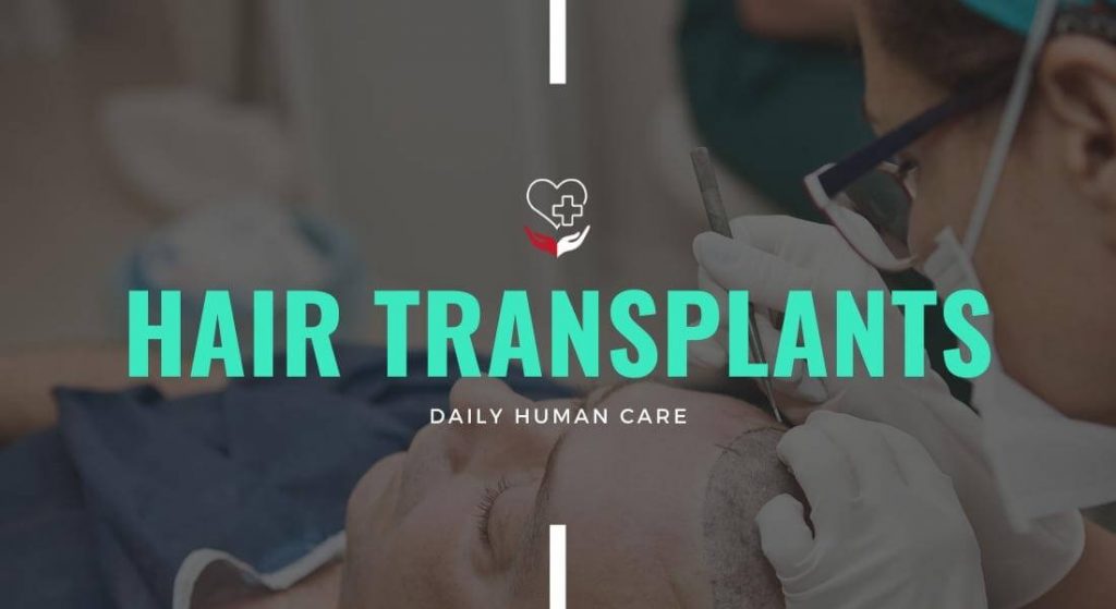 Hair Transplants Everything You Need To Know During 2022 Daily Human