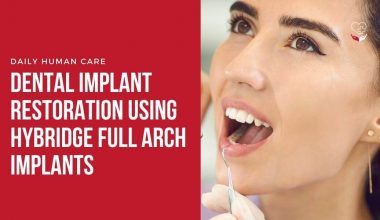 Dental Implant Restoration Using Hybridge Full Arch Implants