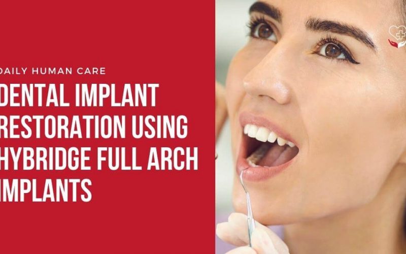 Dental Implant Restoration Using Hybridge Full Arch Implants