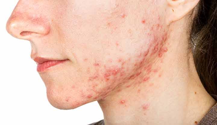 Remove cystic acne