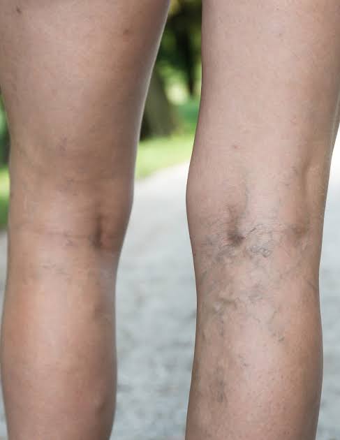 Varicose Vein Treatment