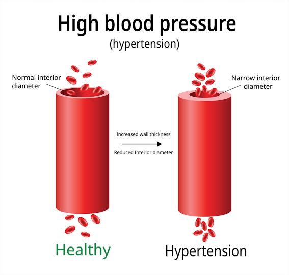 High blood pressure 