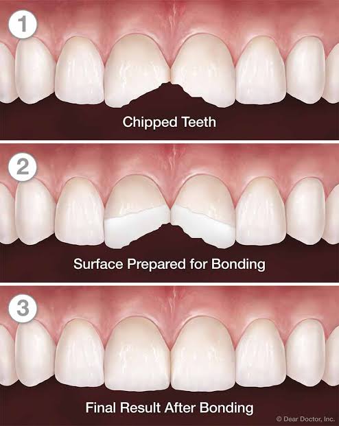 Tooth bonding 