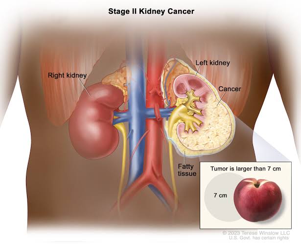 Kidney cancer 