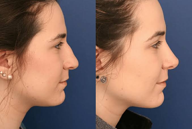 Nose Surgery 