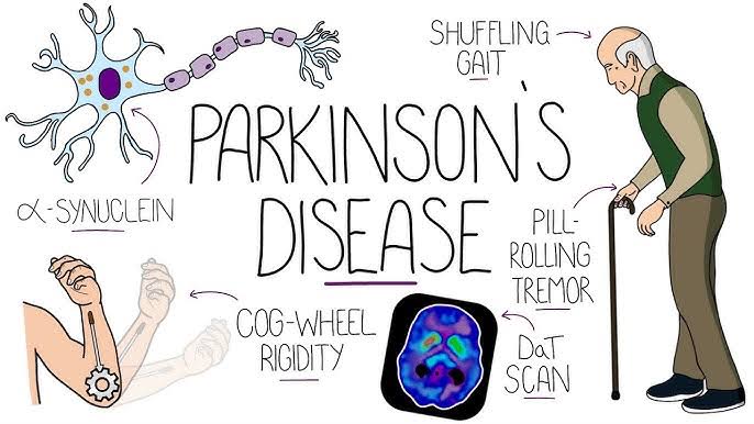Parkinson's Disease
